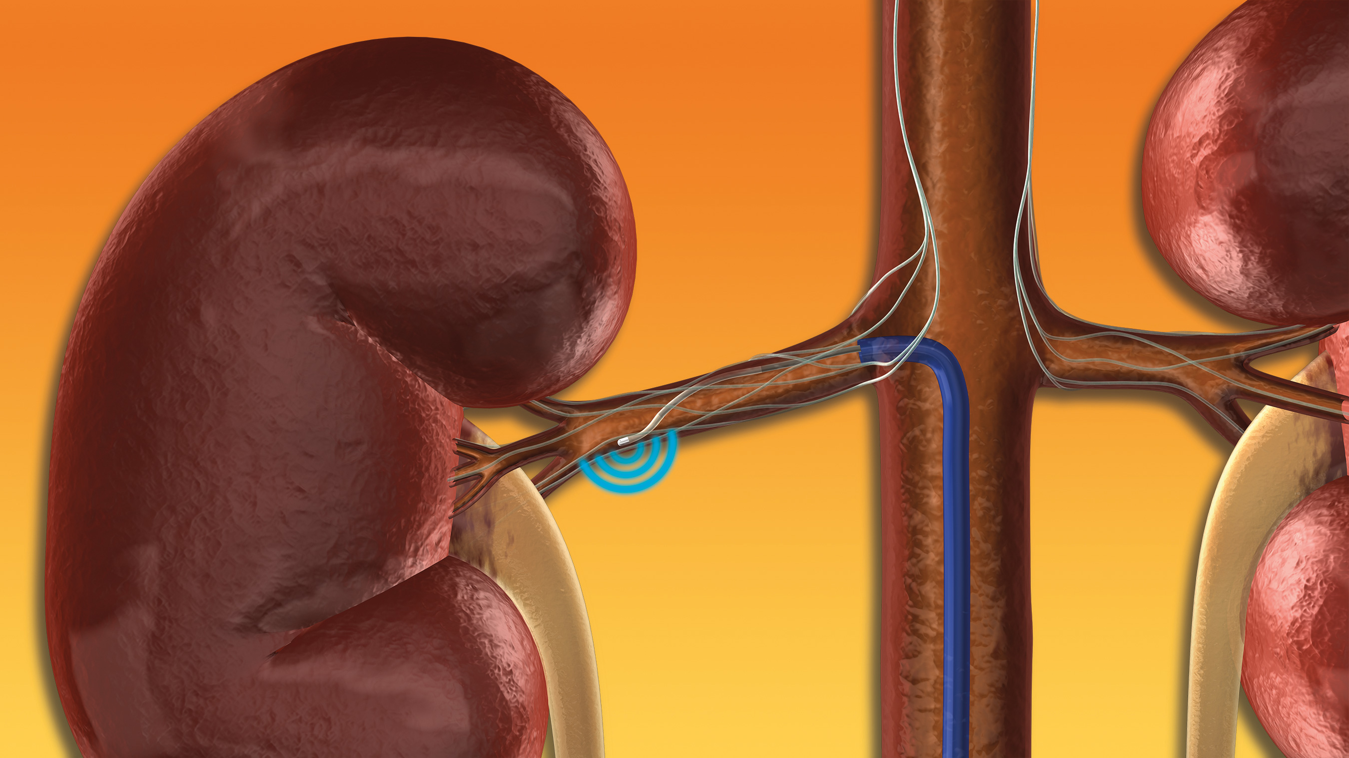 Renale Denervation 